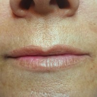 Modelo 1. Labios antes.