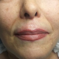 Modelo 4. Labios después de la reparación.