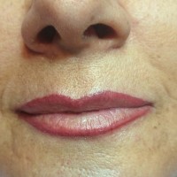 Modelo 1. Labios después.