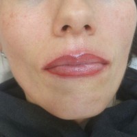 Modelo 2. Labios después.