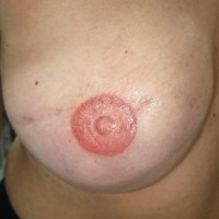 Modelo 3. Estado de la areola mamaria, seno derecho inmediatamente después de la micropigmentación.