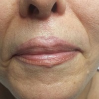 Modelo 4. Labios antes de la reparación. 